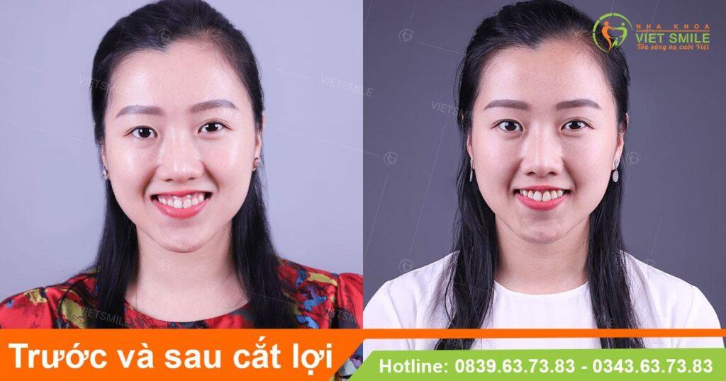 VietSmile Trị Cười Hở Lợi