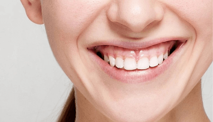 Chi phí chữa cười hở lợi tại nha khoa việt smile