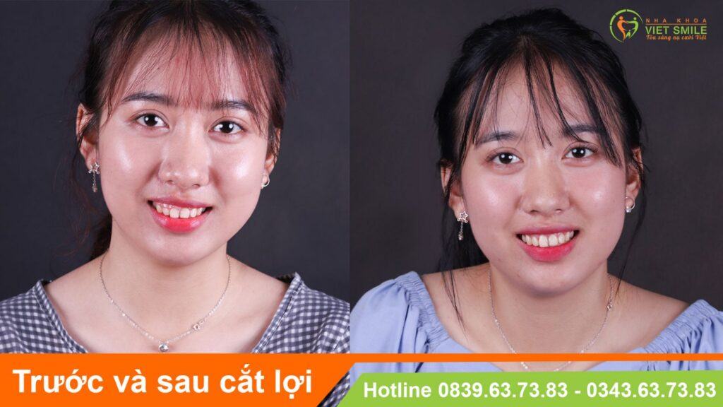 VietSmile Trị Cười Hở Lợi