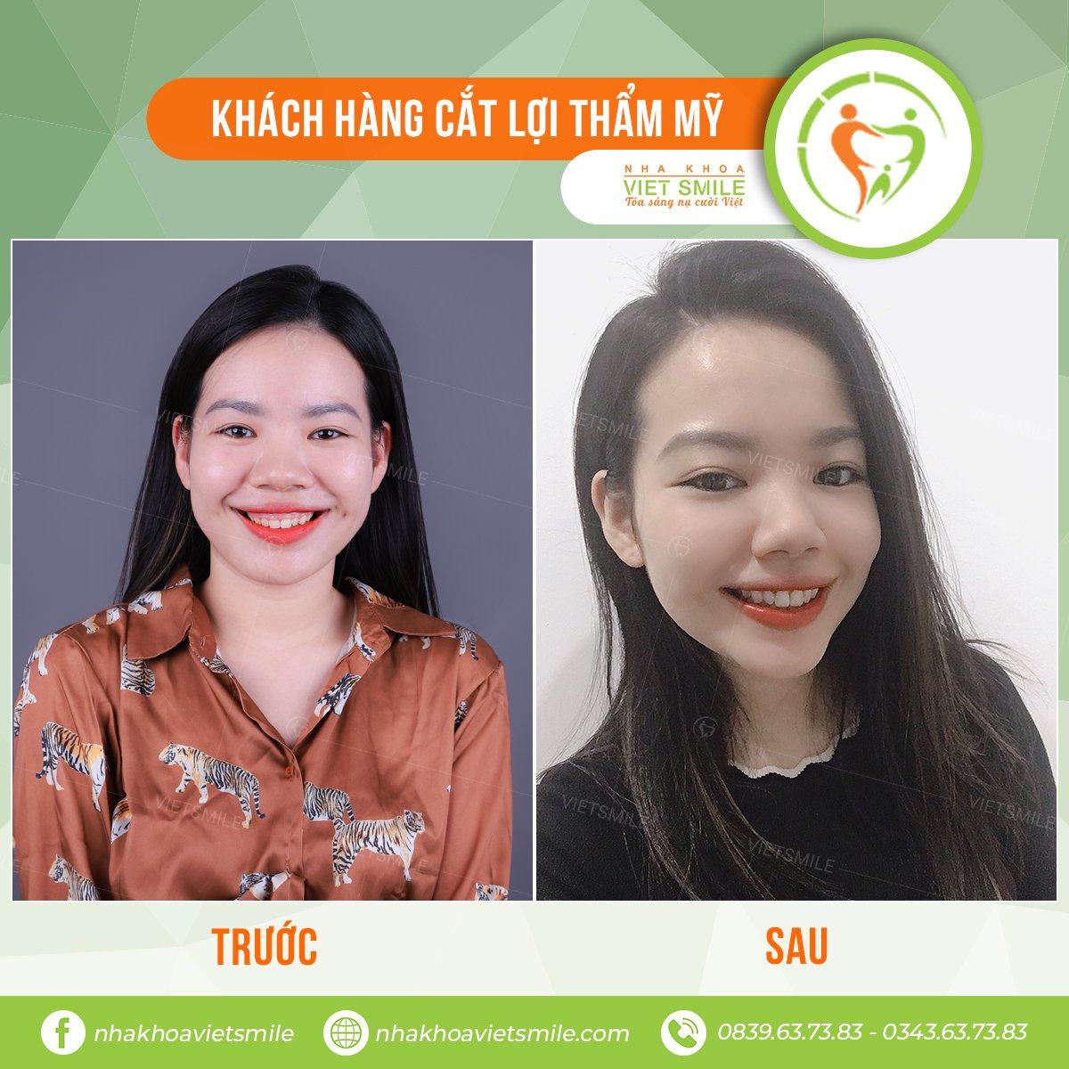 4 mẹo giúp chữa cười hở lợi đơn giản 1 Chua cuoi ho loi