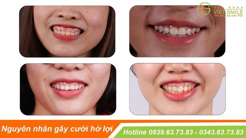 VietSmile Trị Cười Hở Lợi