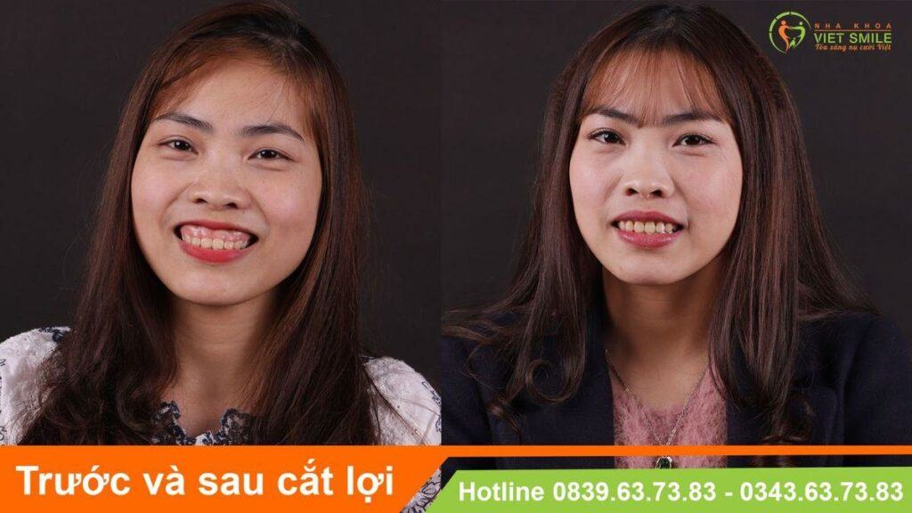 VietSmile Trị Cười Hở Lợi