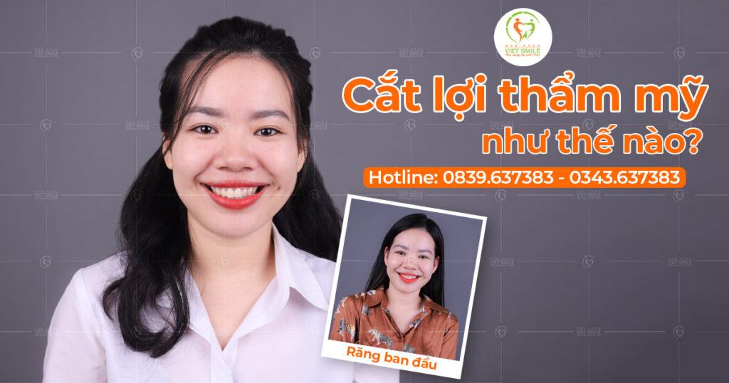 VietSmile Trị Cười Hở Lợi