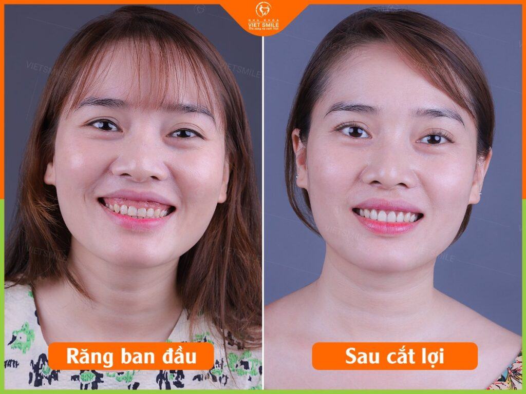 VietSmile Trị Cười Hở Lợi