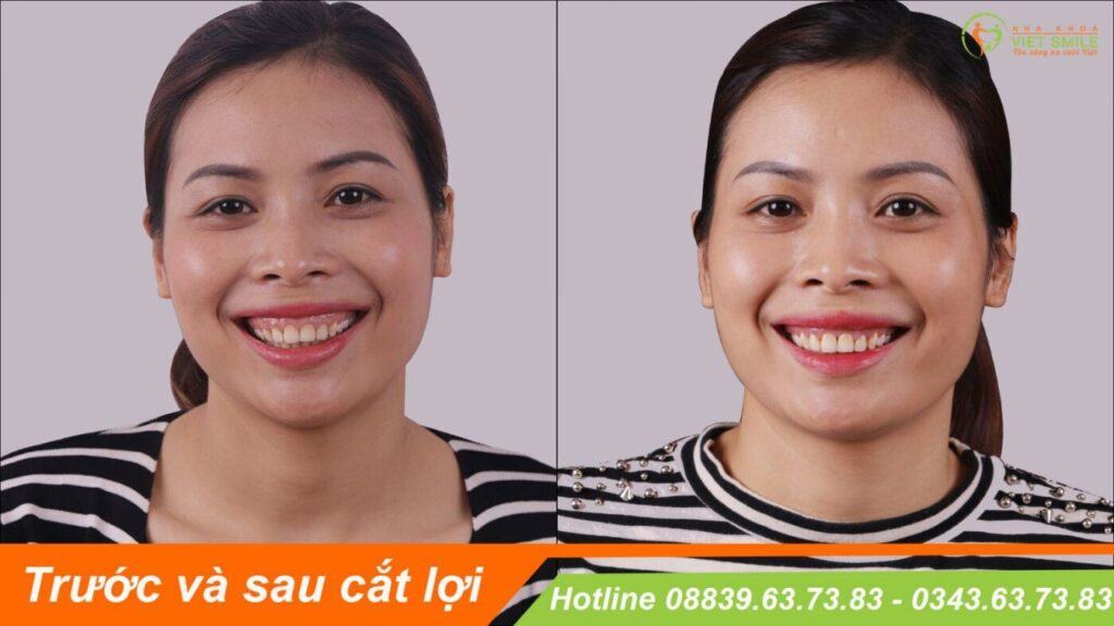 VietSmile Trị Cười Hở Lợi