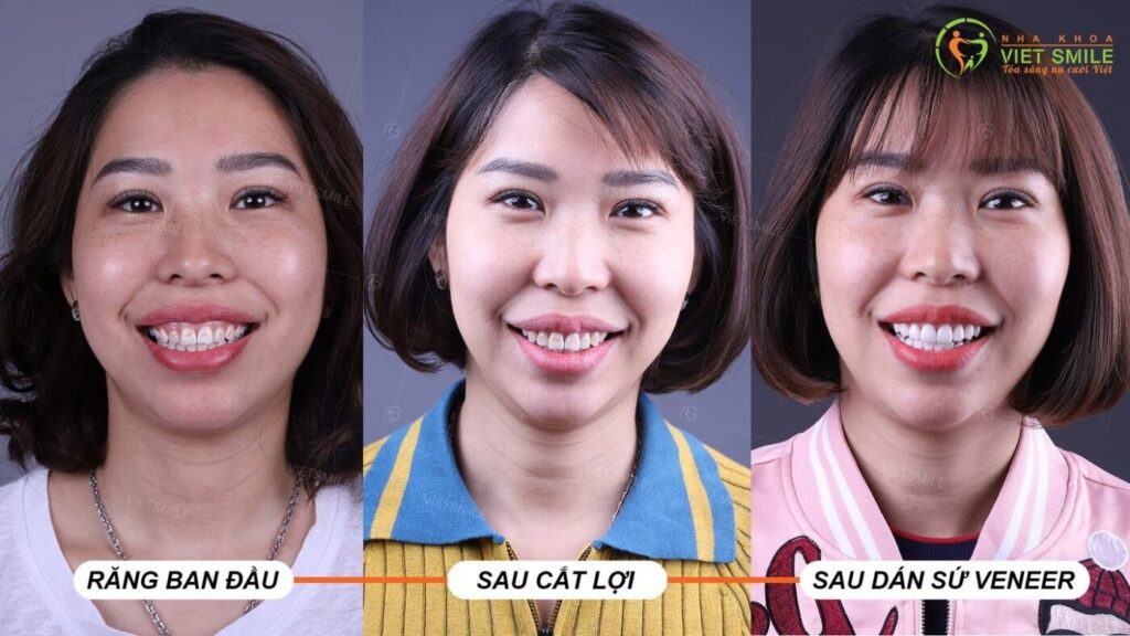 VietSmile Trị Cười Hở Lợi