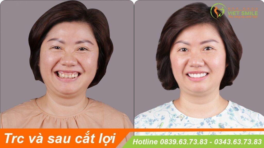 VietSmile Trị Cười Hở Lợi