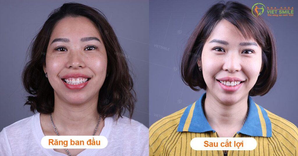 VietSmile Trị Cười Hở Lợi