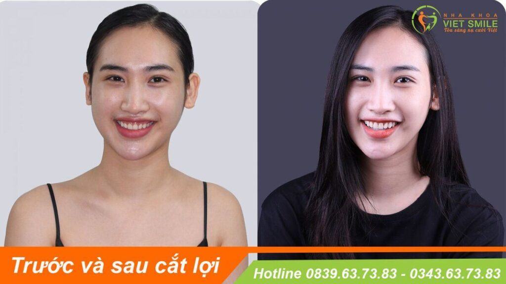 VietSmile Trị Cười Hở Lợi