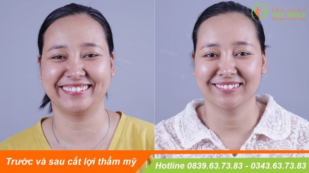 VietSmile Trị Cười Hở Lợi