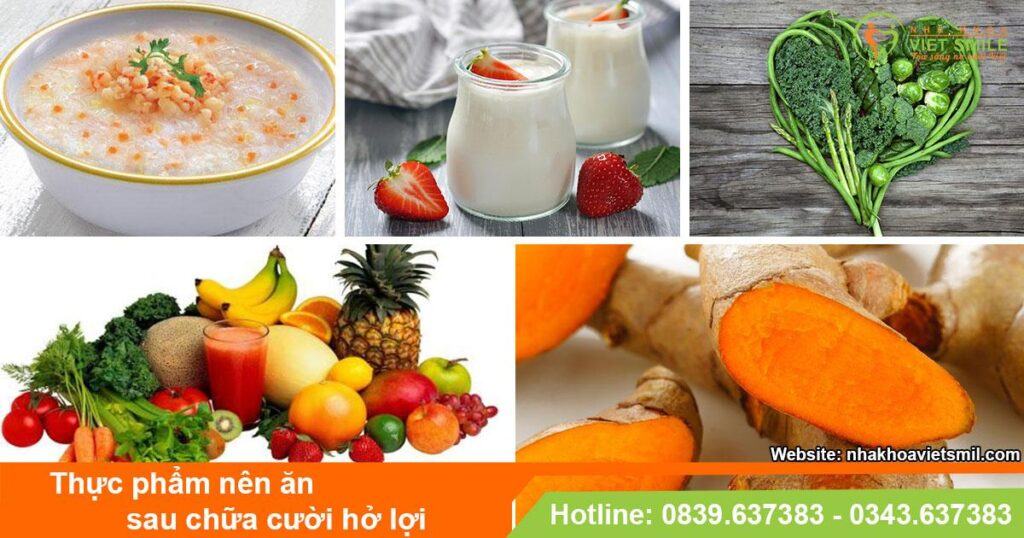 VietSmile Trị Cười Hở Lợi