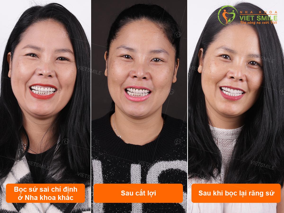 Cắt lợi thẩm mỹ có nguy hiểm không? 3 Khách hàng cắt lợi điều trị cười hở lại và bọc lại răng sứ