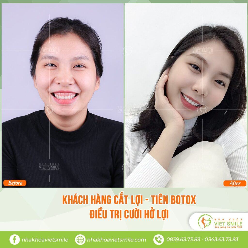 VietSmile Trị Cười Hở Lợi