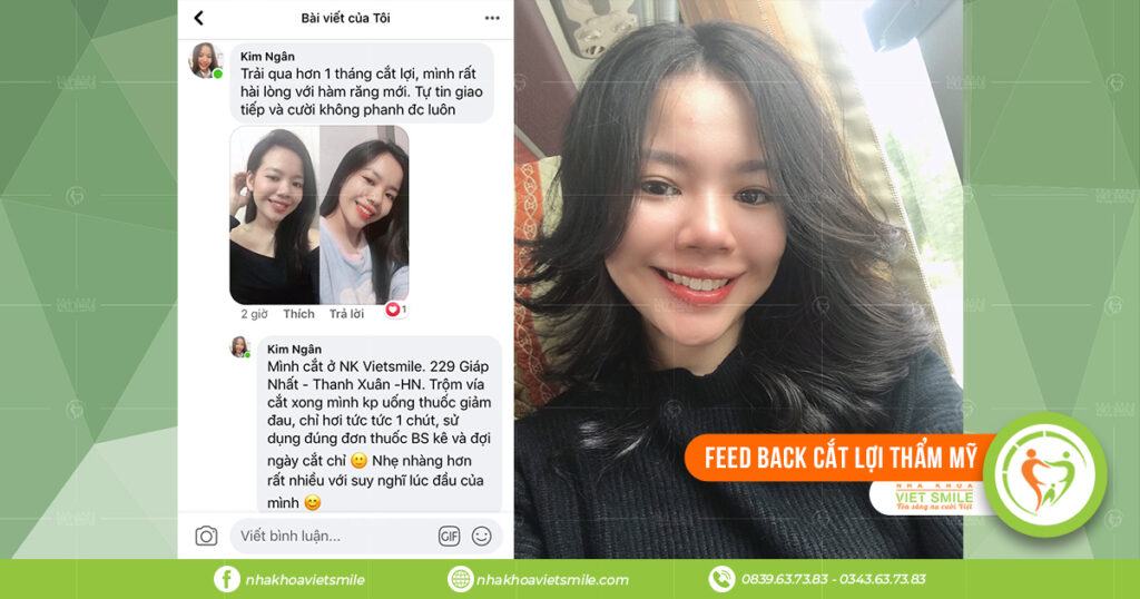 VietSmile Trị Cười Hở Lợi