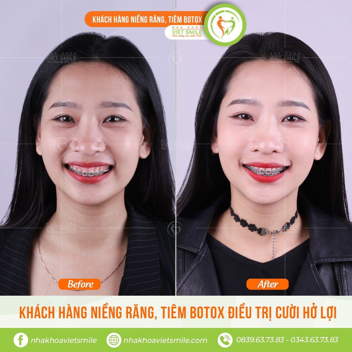 Lưu ý để nhận biết cười hở lợi ở trẻ và cách khắc phục 7 Kéo cơ môi bằng botox