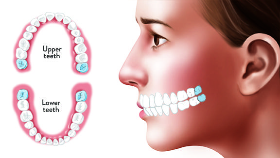 Hình minh họa vị trí răng khôn (màu xanh)
