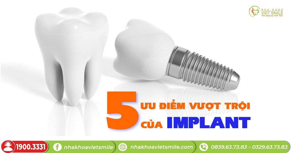 5 ưu điểm vượt trội của implant