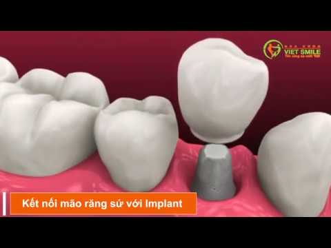 VietSmile Trị Cười Hở Lợi