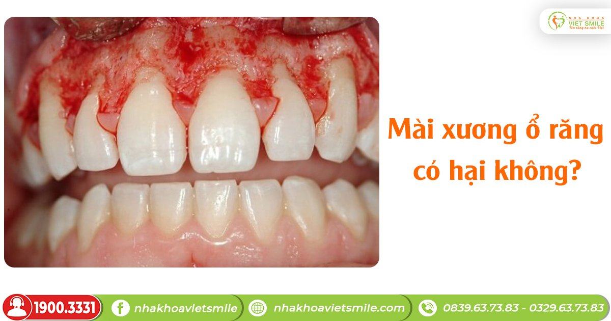 Mài xương ổ răng có hại không?