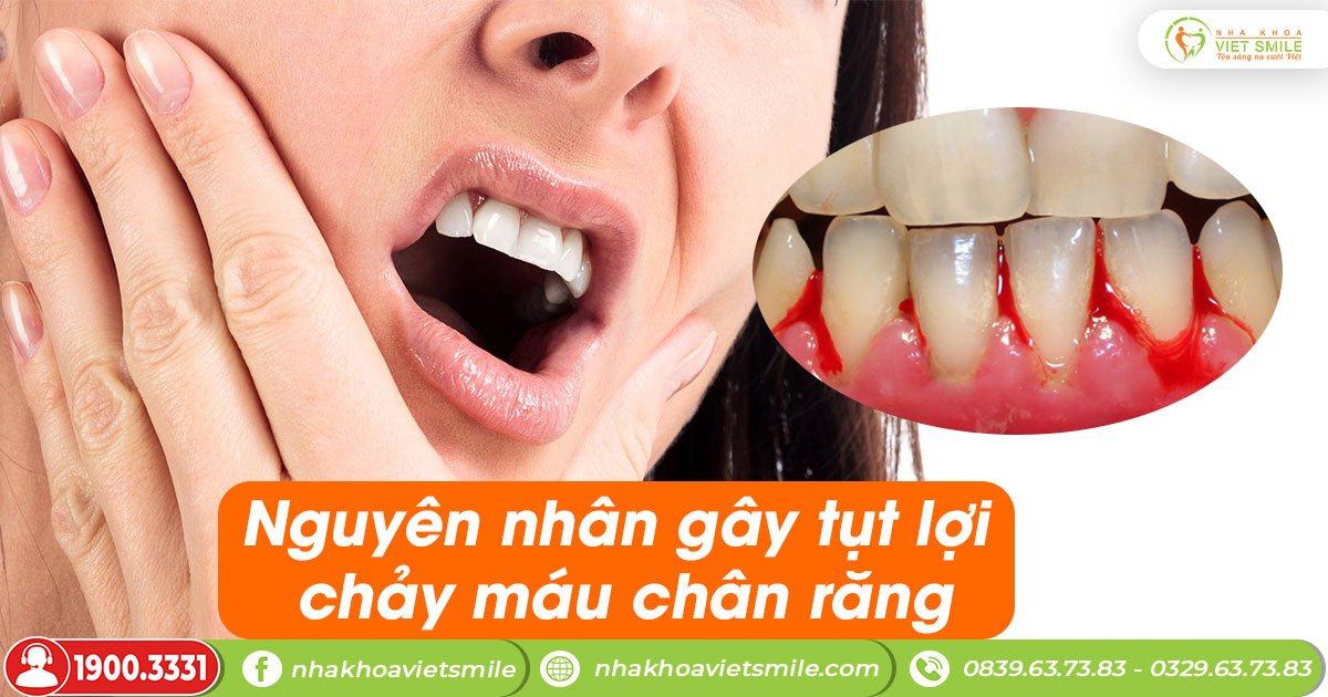 Nguyên nhân gây tụt lợi chảy máu chân răng