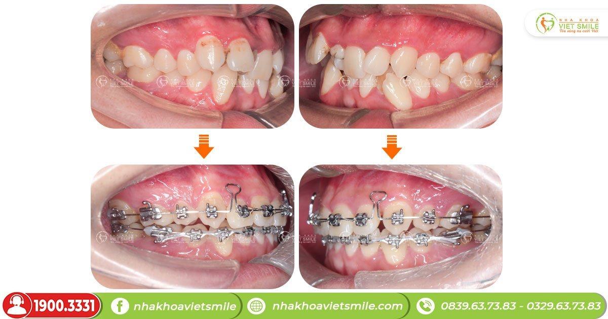 Hậu quả tụt lợi chân răng và những điều cần biết 7 Niềng răng khắc phục tụt lợi