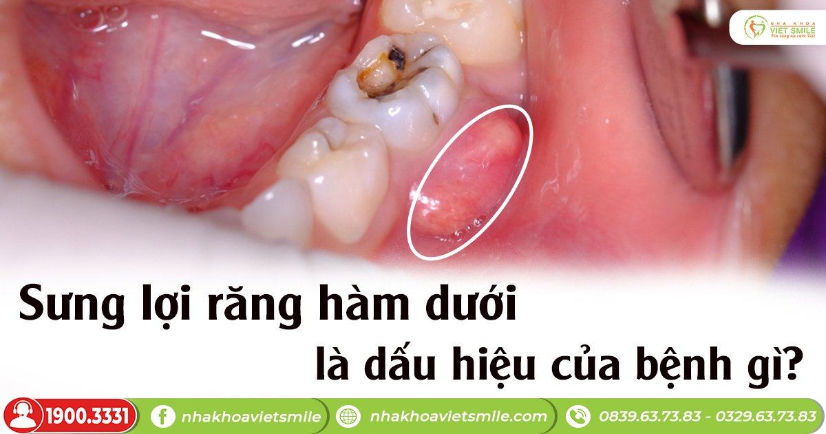 Sưng lợi răng hàm dưới là dấu hiệu của bệnh gì?