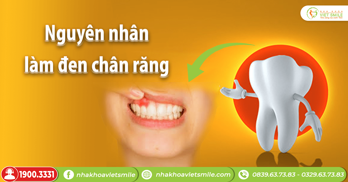 VietSmile Trị Cười Hở Lợi