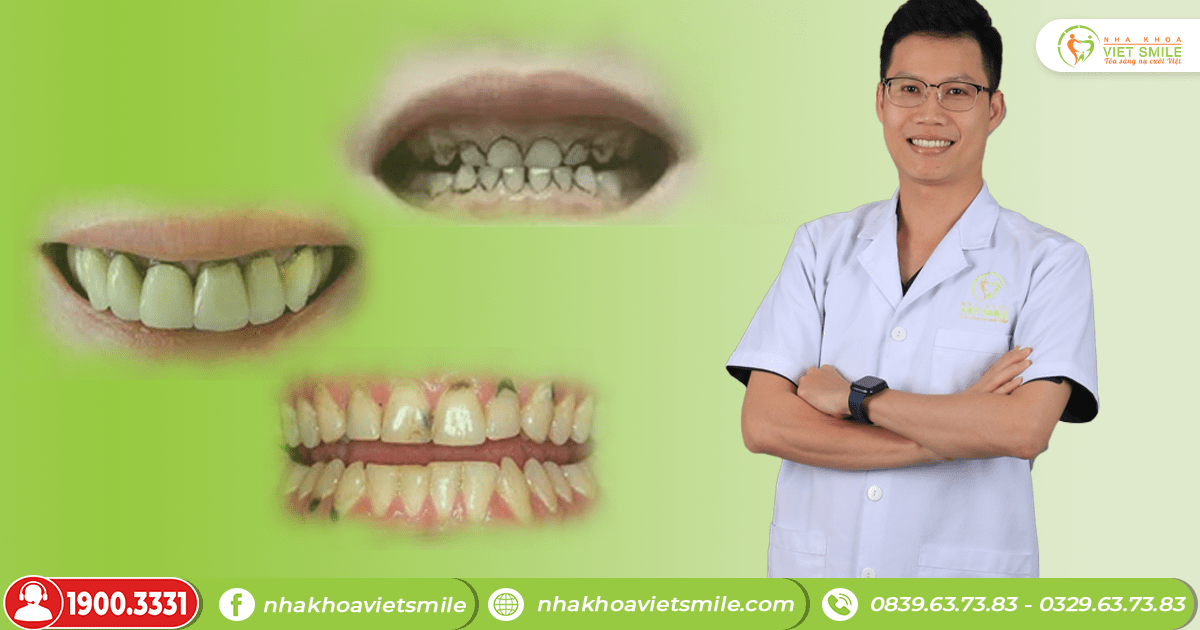 VietSmile Trị Cười Hở Lợi