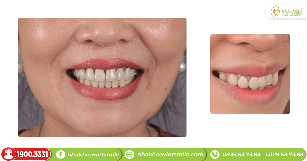 VietSmile Trị Cười Hở Lợi