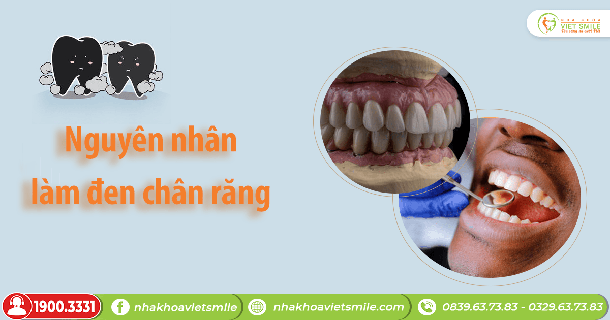 VietSmile Trị Cười Hở Lợi