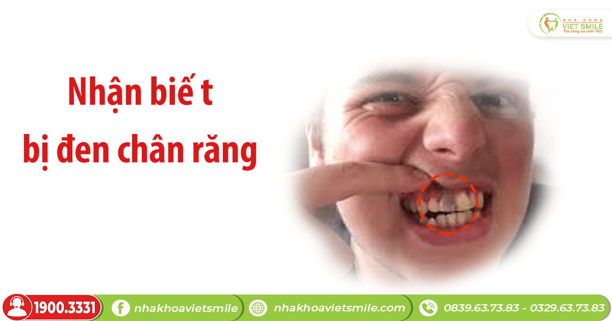 VietSmile Trị Cười Hở Lợi