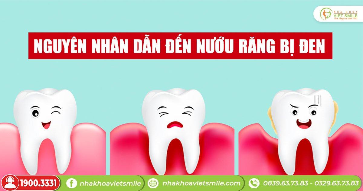 Nguyên nhân dẫn đến nướu răng bị đen