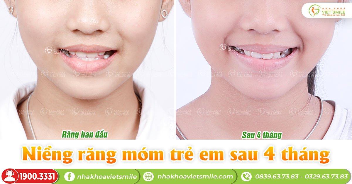VietSmile Trị Cười Hở Lợi