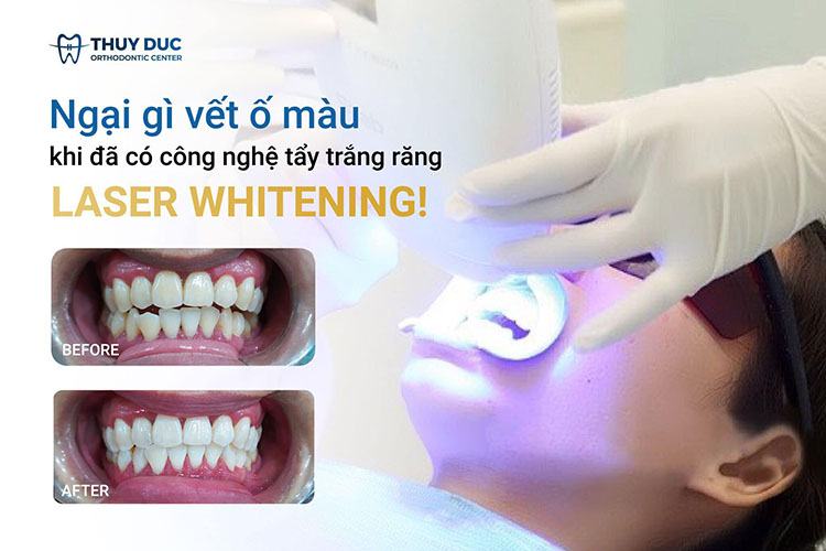 VietSmile Trị Cười Hở Lợi