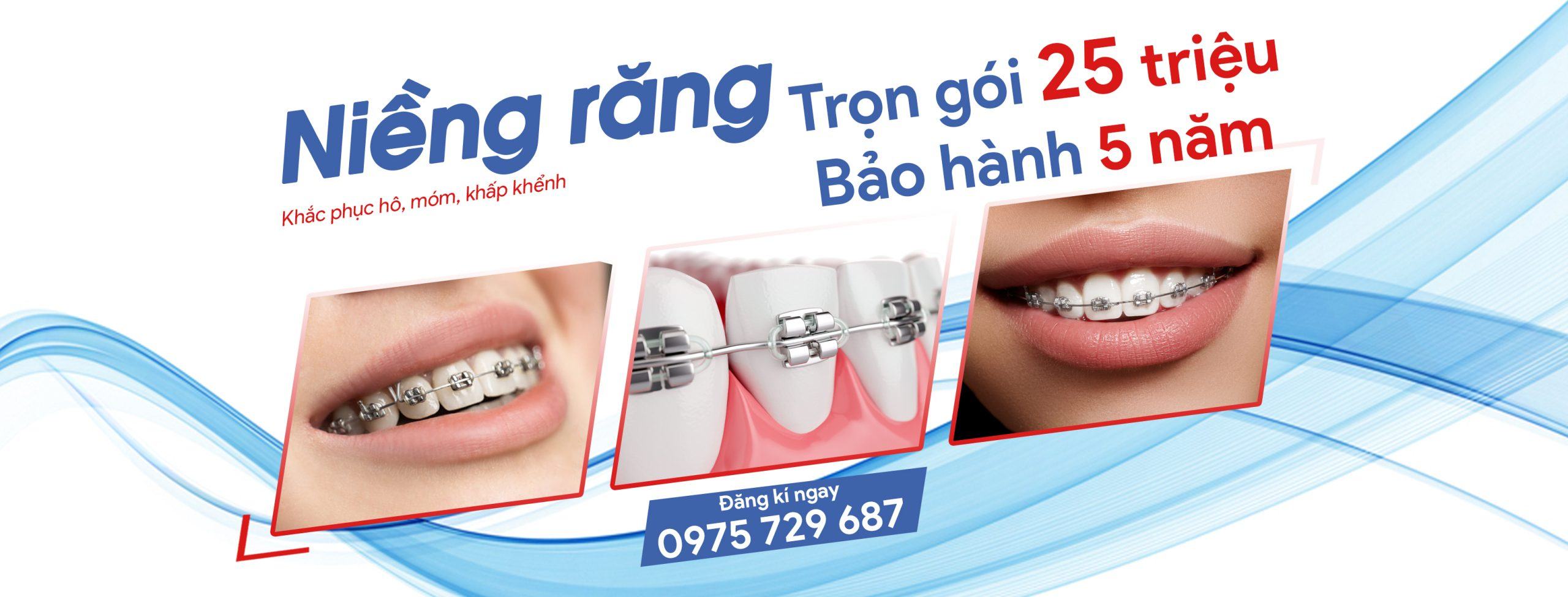 VietSmile Trị Cười Hở Lợi