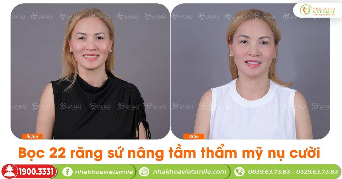 VietSmile Trị Cười Hở Lợi