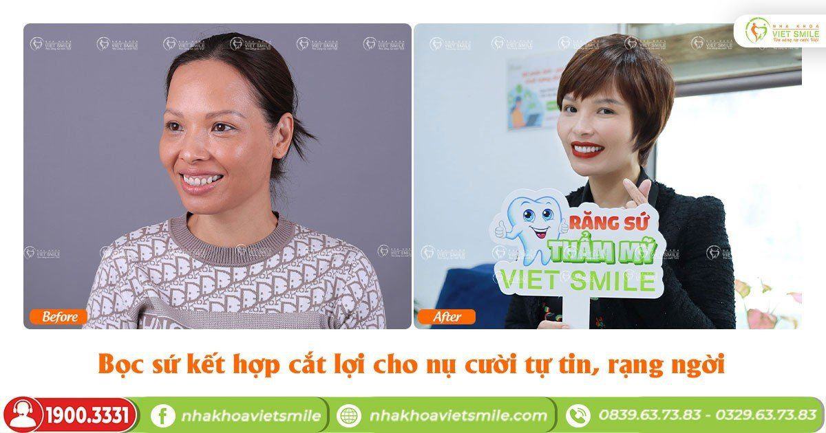 VietSmile Trị Cười Hở Lợi