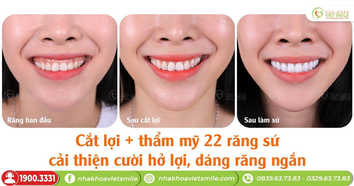 VietSmile Trị Cười Hở Lợi