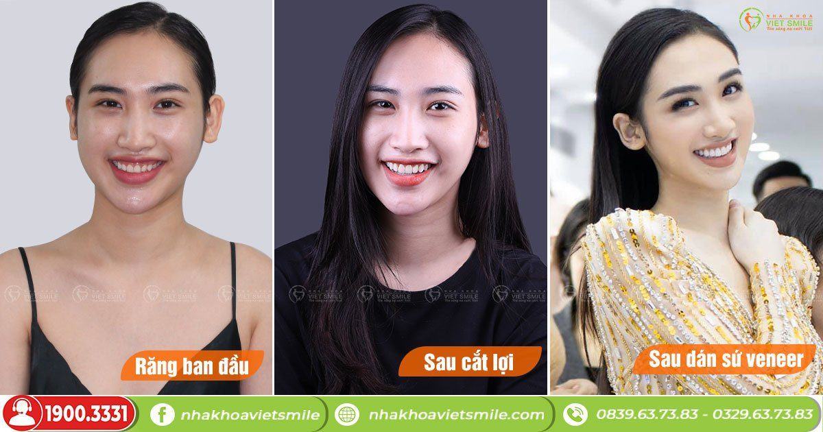 VietSmile Trị Cười Hở Lợi