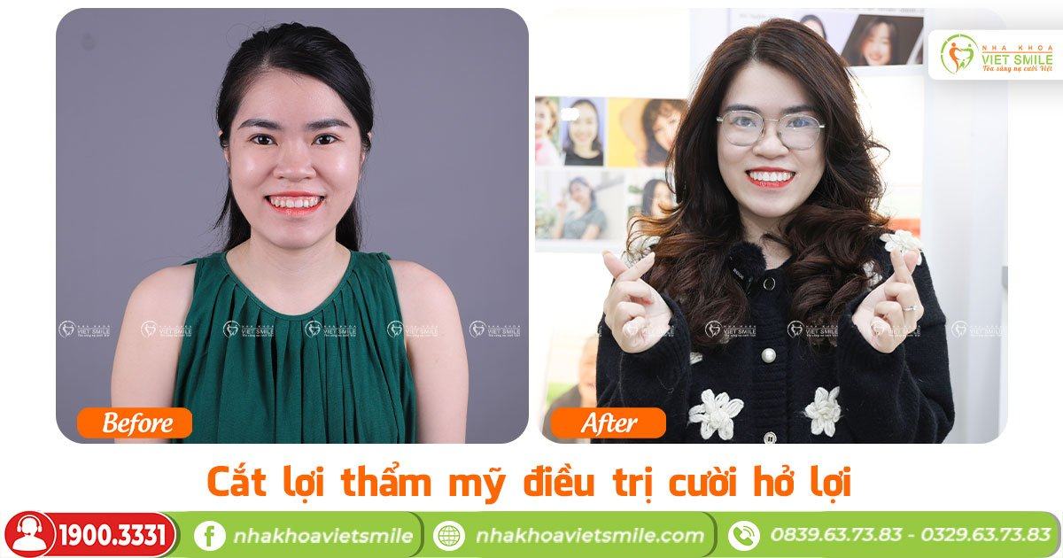 VietSmile Trị Cười Hở Lợi