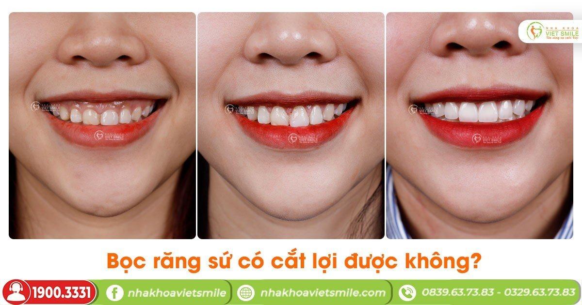 VietSmile Trị Cười Hở Lợi
