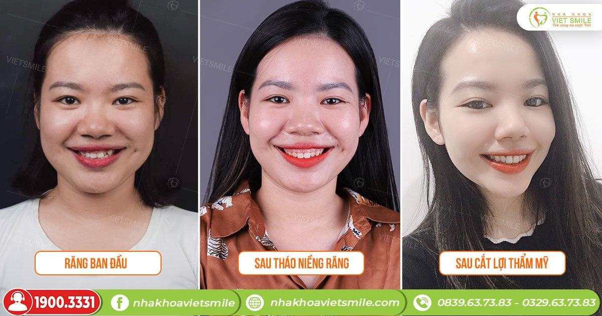 VietSmile Trị Cười Hở Lợi