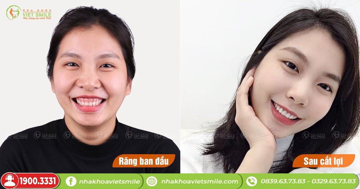 VietSmile Trị Cười Hở Lợi