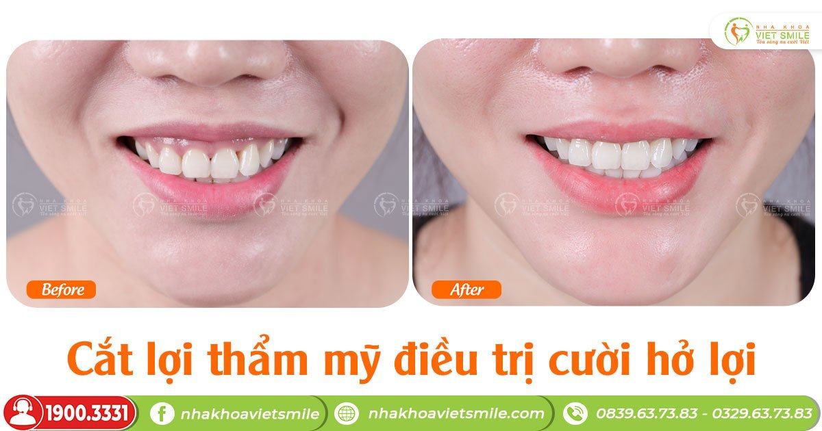 VietSmile Trị Cười Hở Lợi