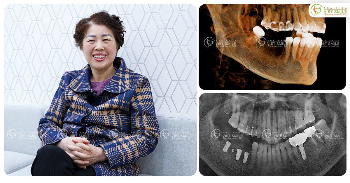 VietSmile Trị Cười Hở Lợi