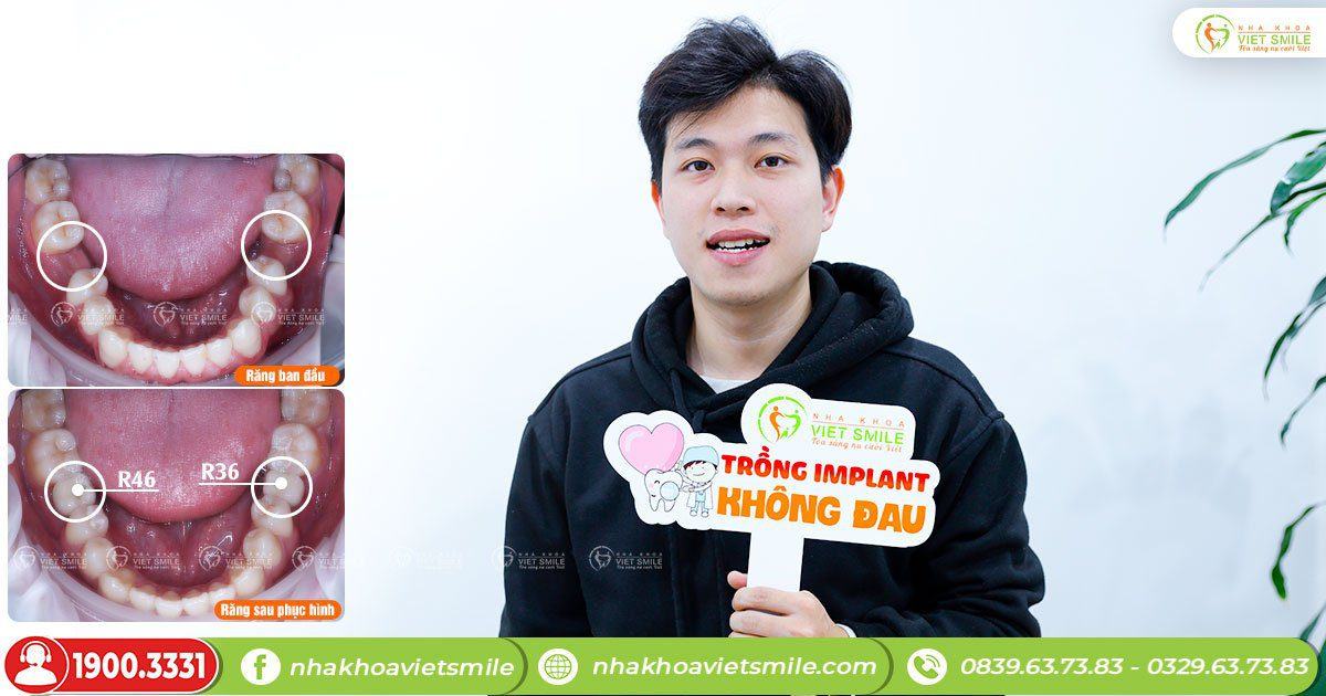 VietSmile Trị Cười Hở Lợi