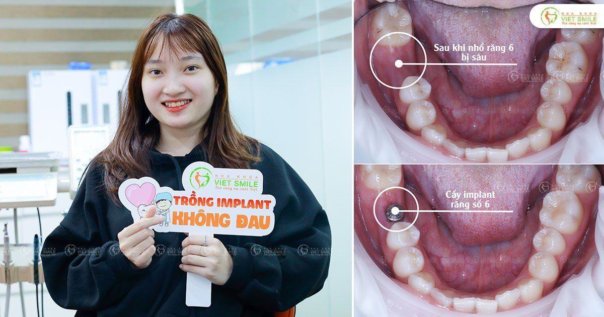 VietSmile Trị Cười Hở Lợi