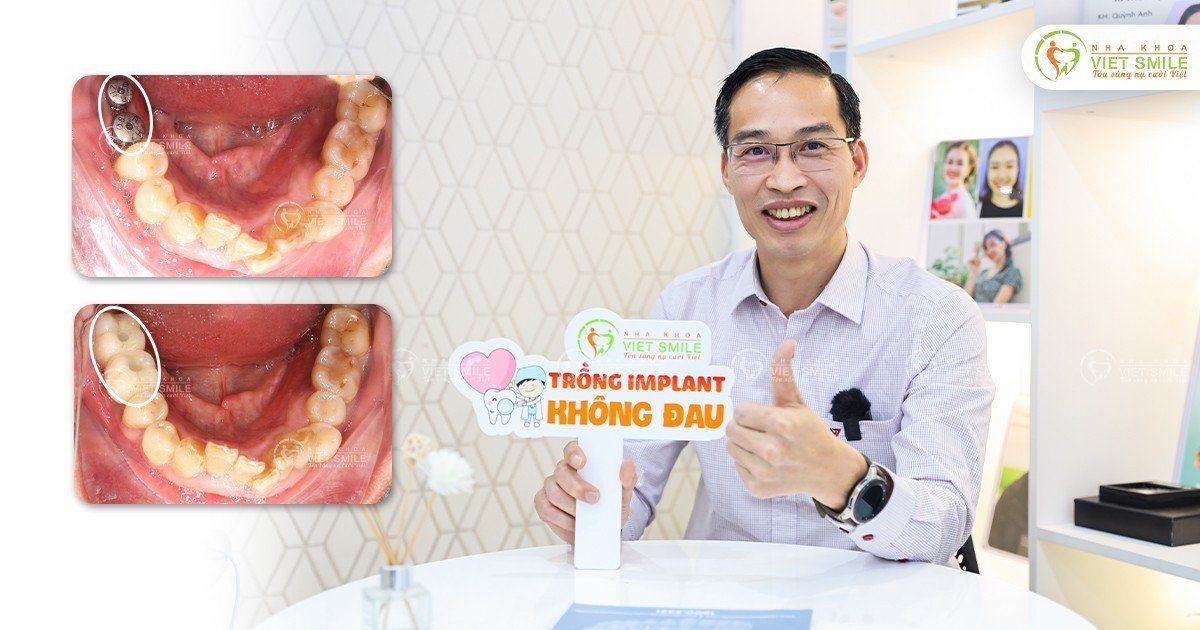 VietSmile Trị Cười Hở Lợi