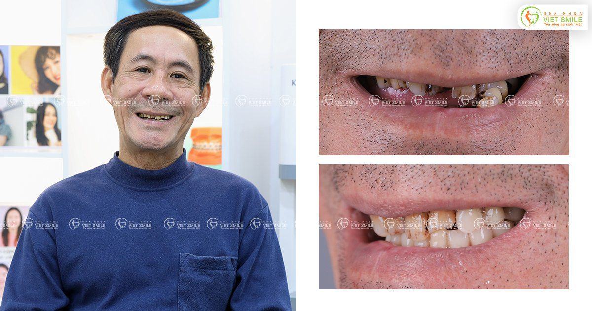 VietSmile Trị Cười Hở Lợi