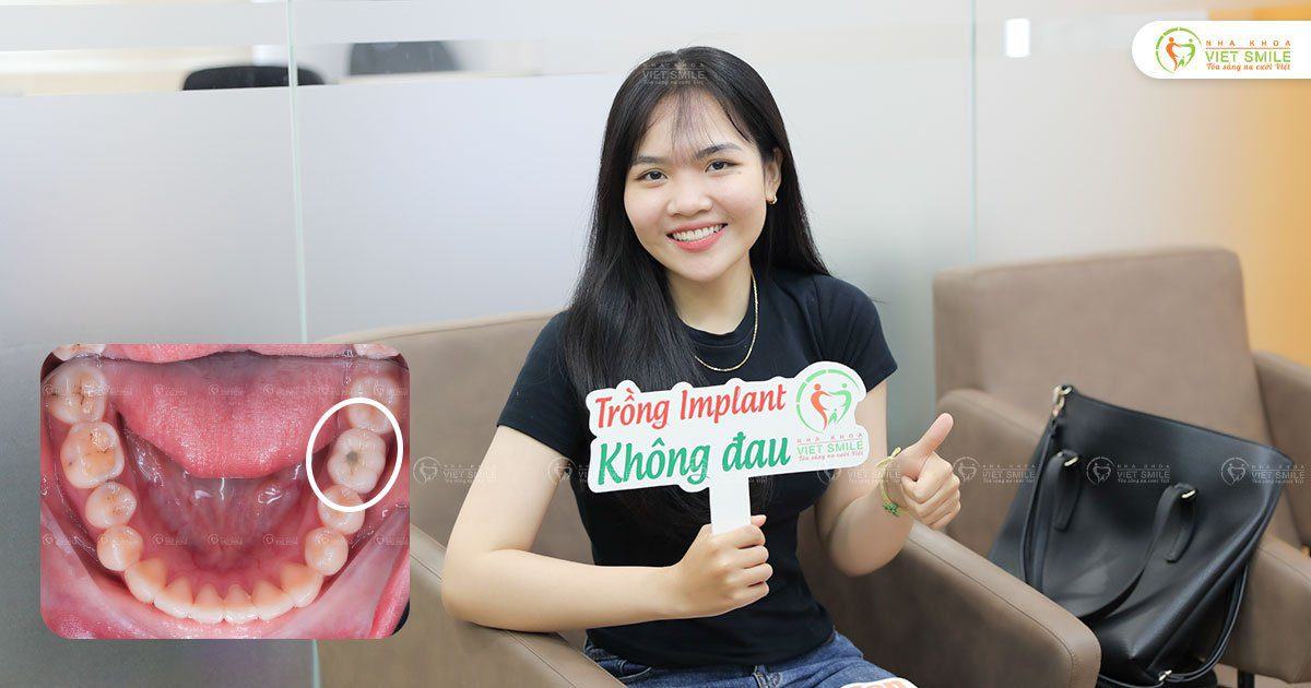 VietSmile Trị Cười Hở Lợi